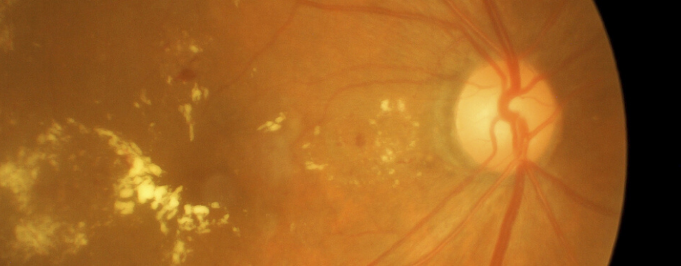 Example of Diabetic Eye Disease