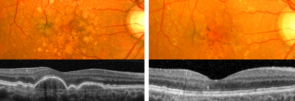 Left: before statin treatment; right: same patient, one year after statin treatment