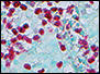 Ocular Oncology