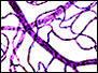 Diabetic retinopathy