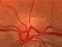 optic-nerve.jpg
