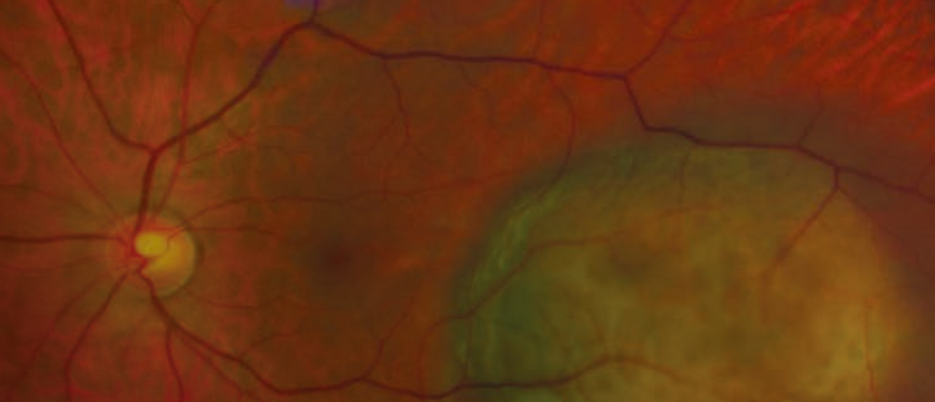 Uveal Melanoma